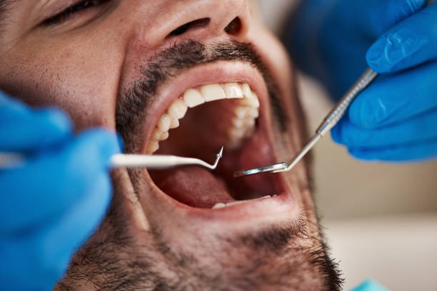 Best Cracked Tooth Emergency Dentist  in Rson, CA